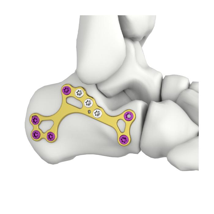 Itval Calcaneal MIS Pagkakandado ng Plata