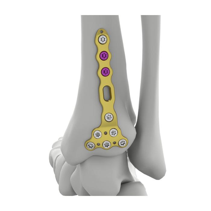 Platang Nakakandado ng Tibial Posterior Distal