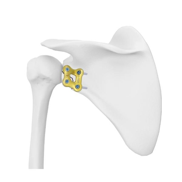 Platang Nakakandado sa Glenoid