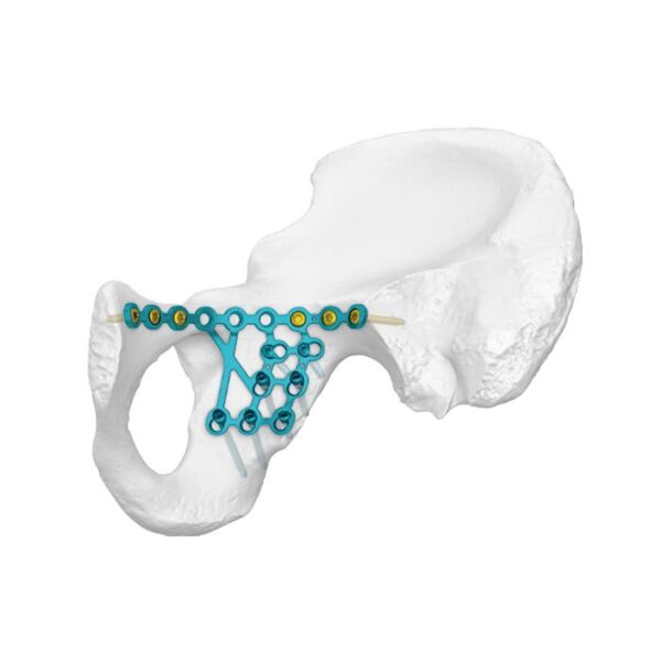 Mababang Posterior na Column Infra-arcuate Line Locking Plate