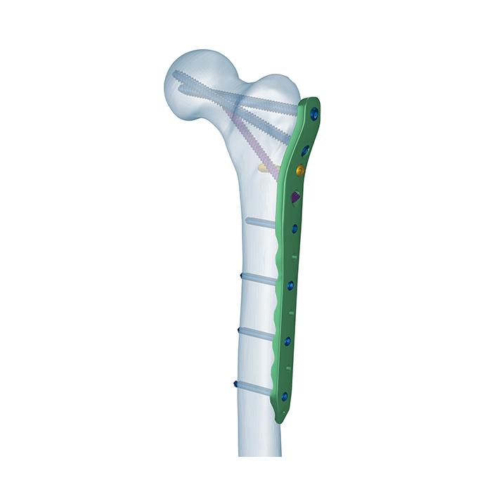 Platang Nakakulong ng Proksimal na Femur