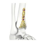 Platang Nakakalagay sa Tibia na Distal Anterior