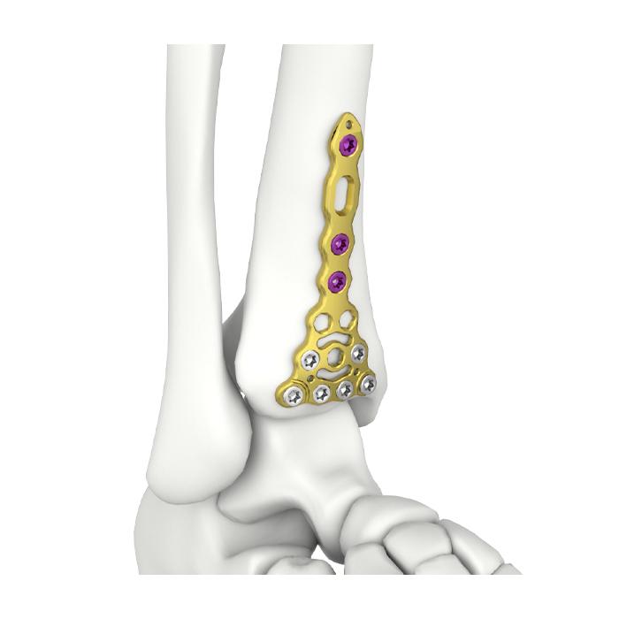Platang Nakakalagay sa Tibia na Distal Anterior