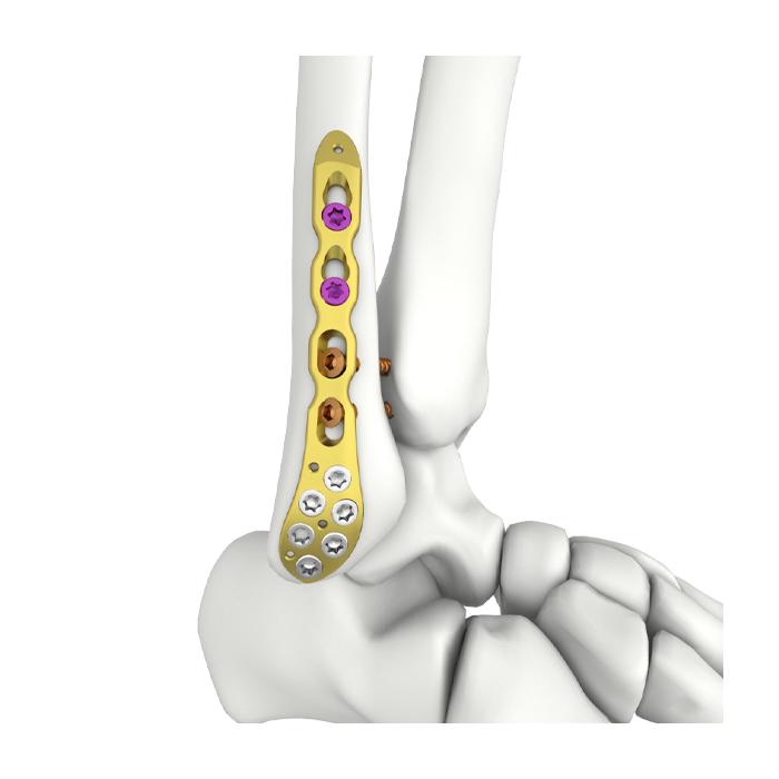 Platang Nakakabit sa Distal Lateral Fibular