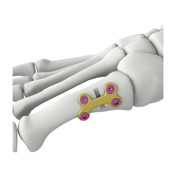 Platang Nakakandado para sa Unang Osteotomiya ng Metatarsal