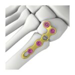 Itval L-hugis na Plaka ng Pagkakandado